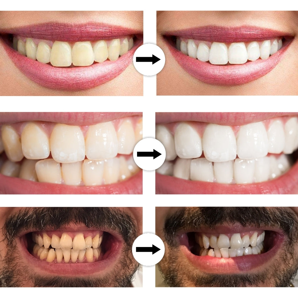 Tandblekningspenna – Kliniskt inspirerad tandblekning hemma